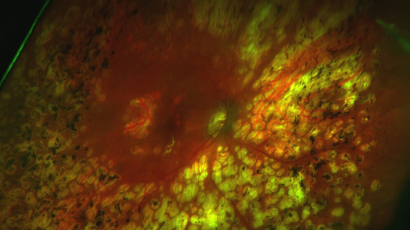 Reflections on retinal photocoagulation