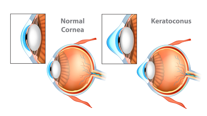 Keratoconus classification