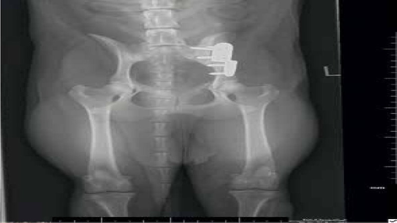 Figure 1. A postoperative radiograph following a triple pelvic osteotomy