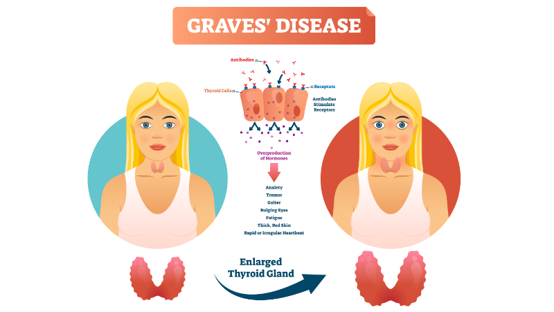 Thyroid eye disease