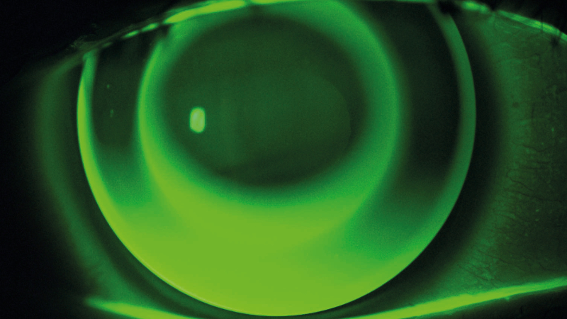 BCLA CLEAR – 2: Contact lens complications
